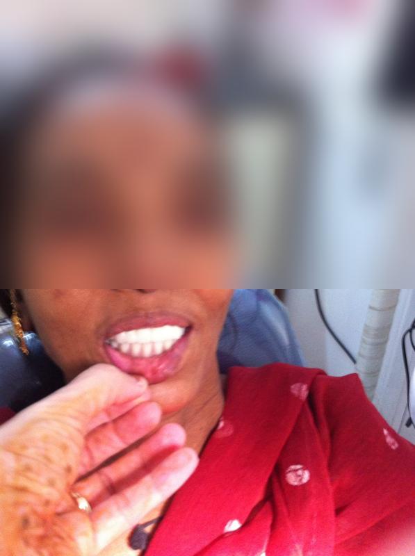 Full Mouth Denture β After
