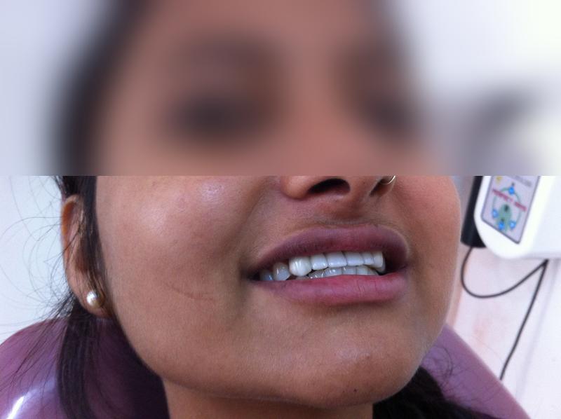 Anterior Teeth Replacement β After