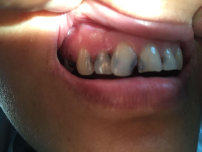 Smile Restoration β Before
