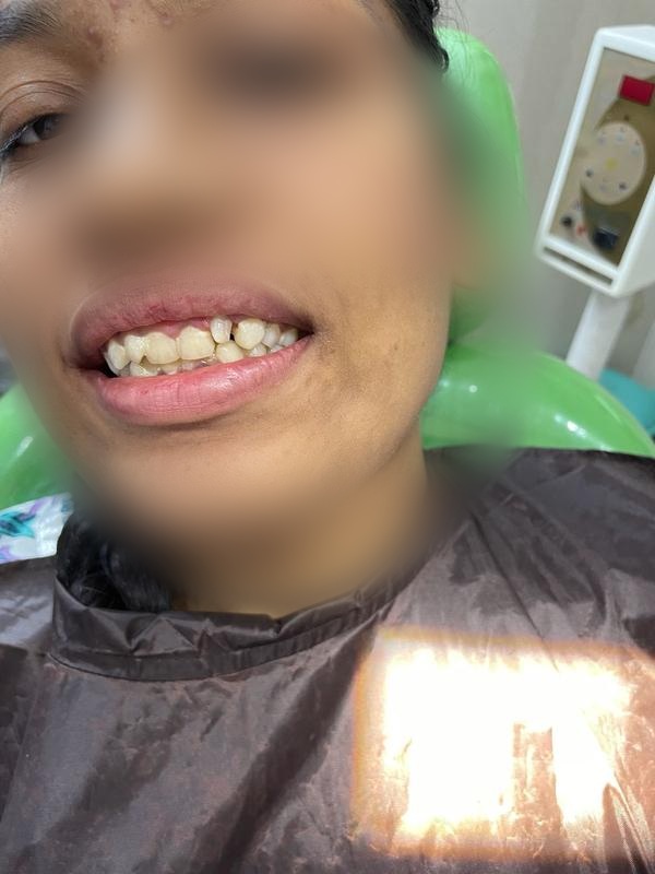 Root Canal + Crown β Before