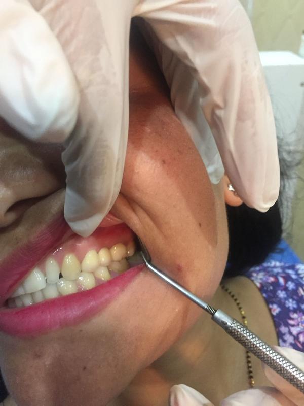 RCT + Zirconia Crown β After